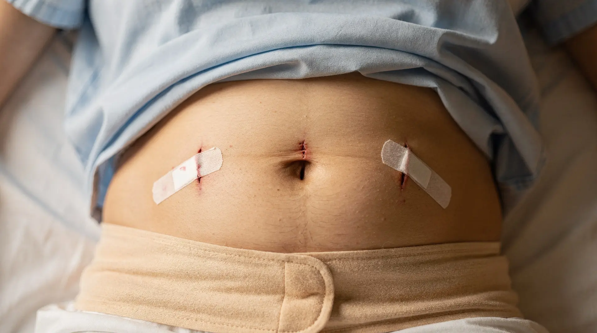 hernie inguinale opération